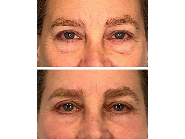 eyelid-brow-7-3-updated