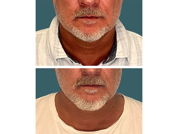 necklift-4-5-updated