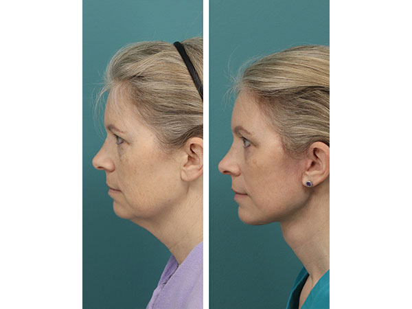 face-neck-rejuv-26-1