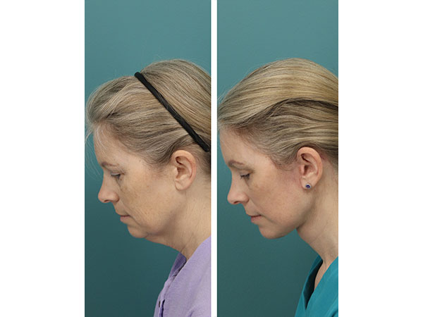face-neck-rejuv-26-2