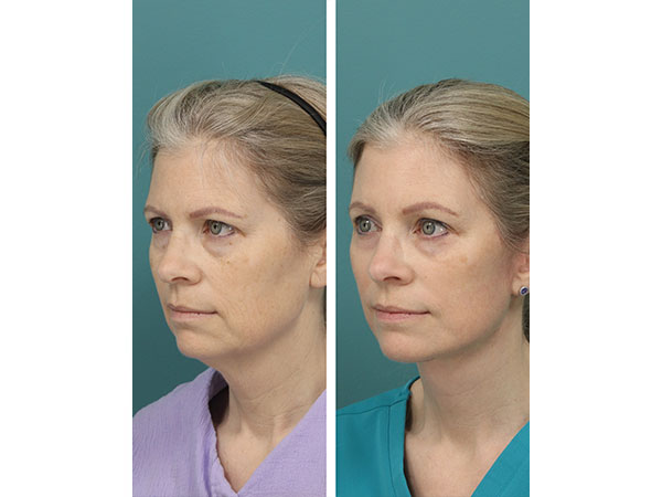 face-neck-rejuv-26-3