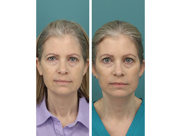 face-neck-rejuv-26-4