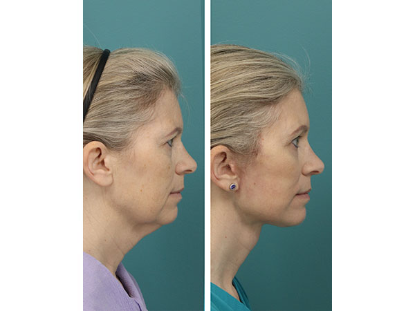 face-neck-rejuv-26-6