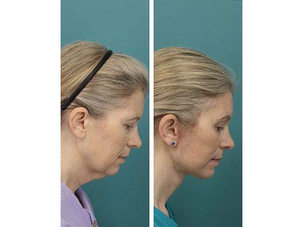 face-neck-rejuv-26-7