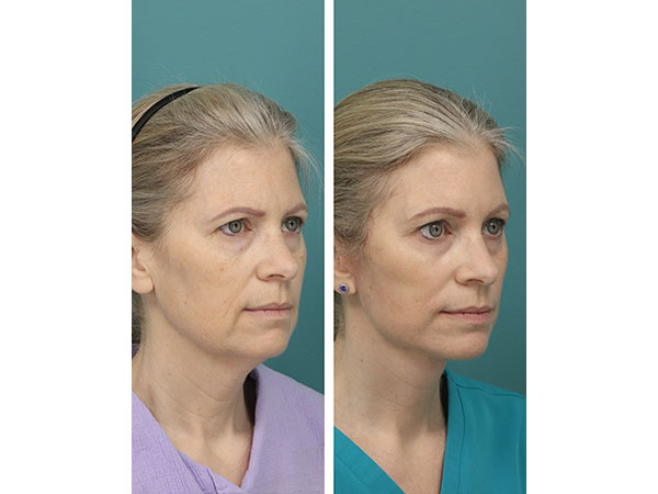 face-neck-rejuv-26-8