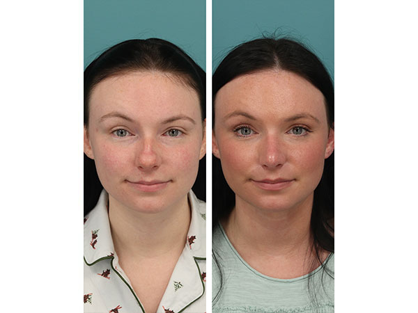 rhinoplasty-14-1