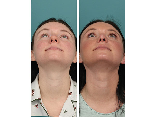 rhinoplasty-14-2