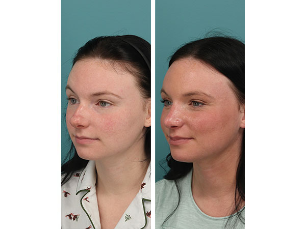 rhinoplasty-14-3