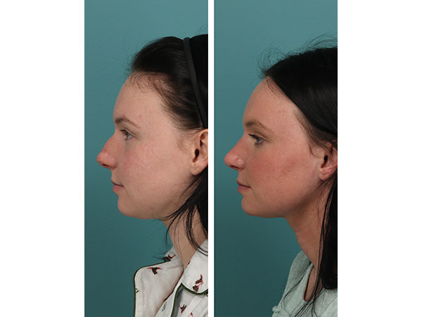 rhinoplasty-14-4