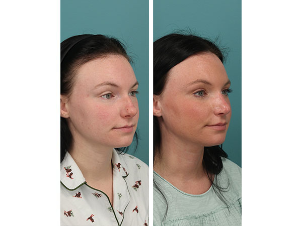 rhinoplasty-14-6