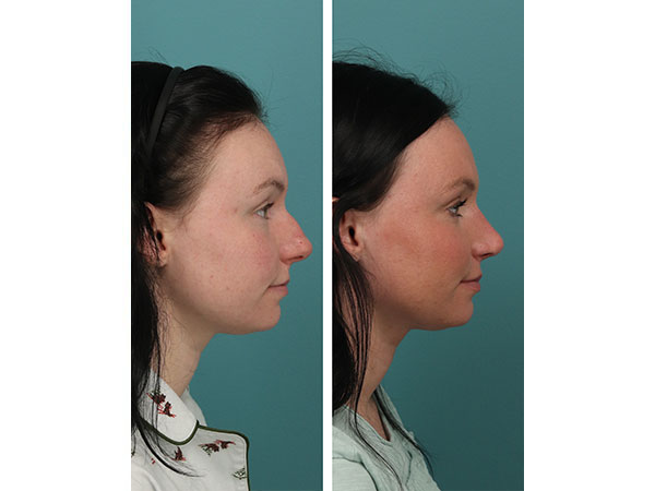 rhinoplasty-14-7