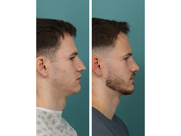 rhinoplasty-15-1