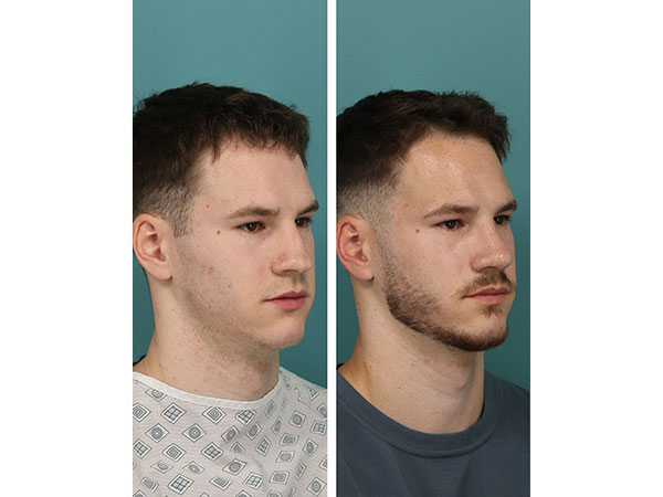 rhinoplasty-15-2