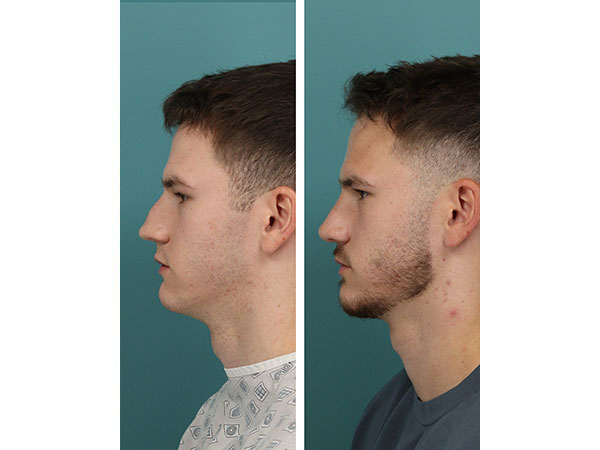 rhinoplasty-15-4