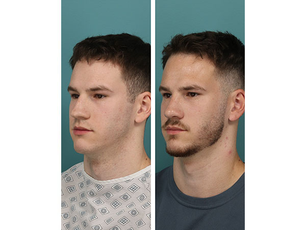 rhinoplasty-15-5