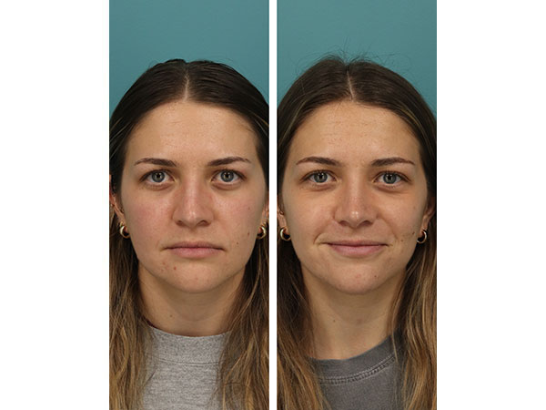 rhinoplasty-16-1