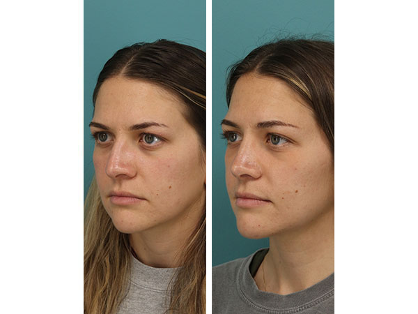 rhinoplasty-16-2