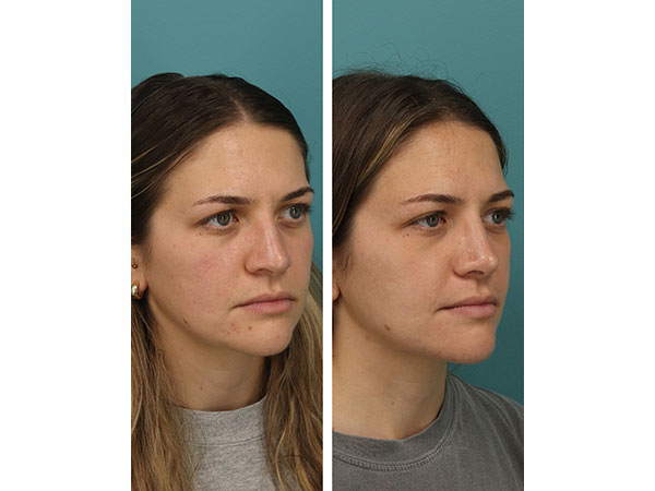 rhinoplasty-16-3
