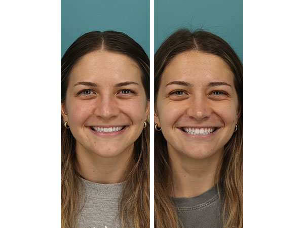 rhinoplasty-16-4