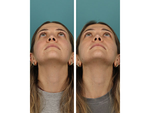 rhinoplasty-16-5