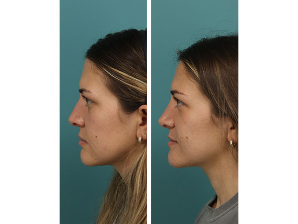 rhinoplasty-16-6