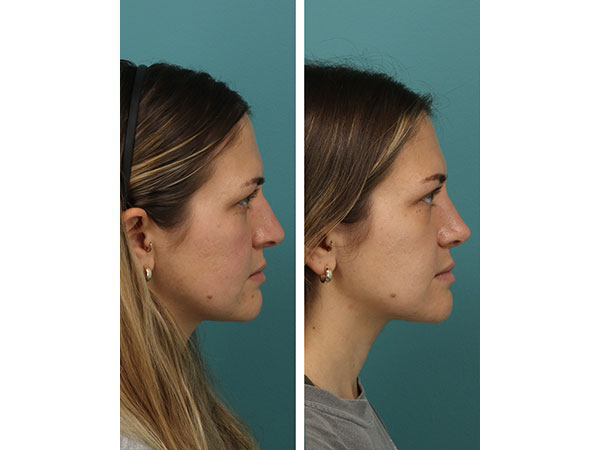 rhinoplasty-16-7