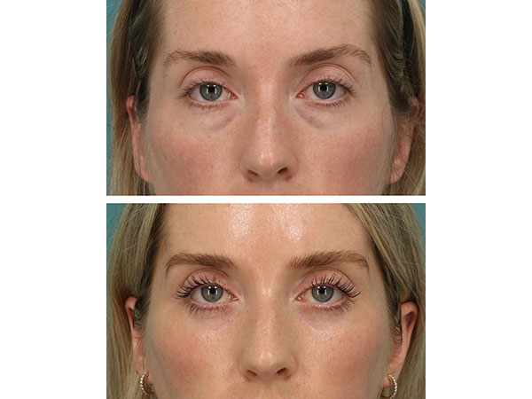 eyelid-brow-18-1