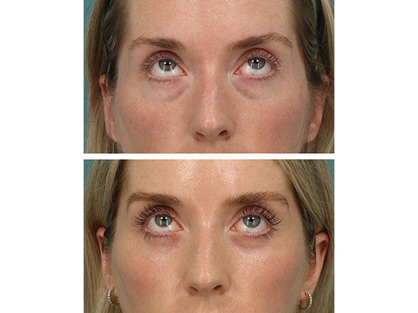 eyelid-brow-18-2