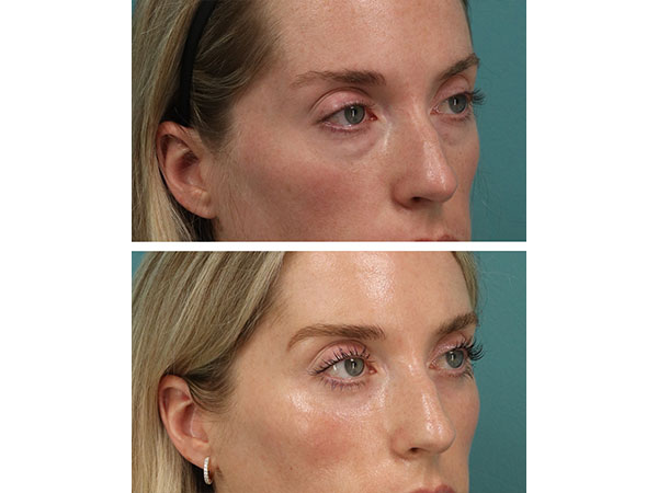 eyelid-brow-18-3