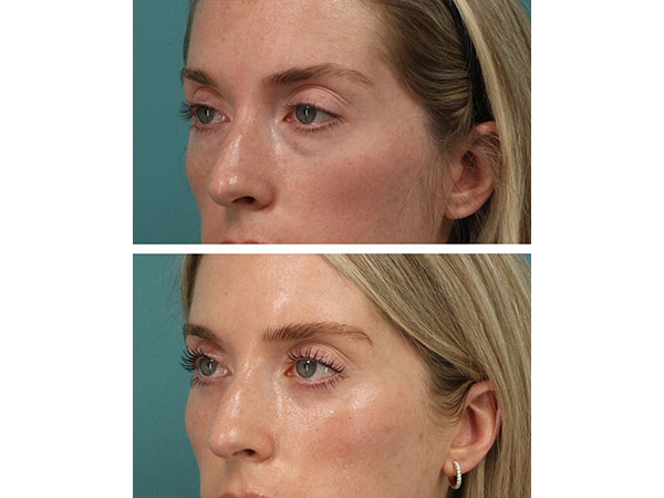 eyelid-brow-18-4