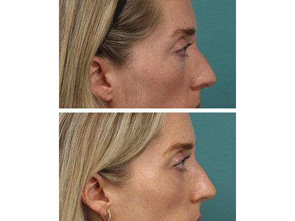 eyelid-brow-18-5