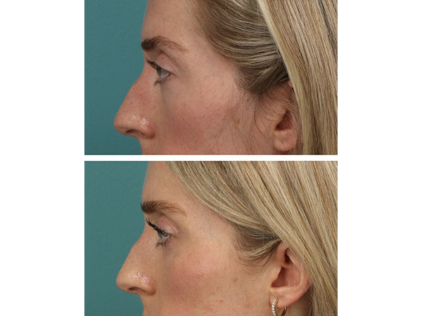 eyelid-brow-18-6