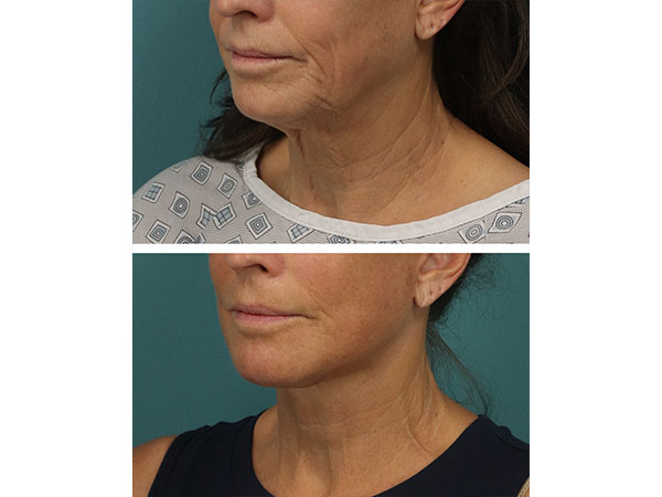 face-neck-rejuv-27-1