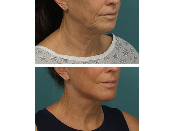 face-neck-rejuv-27-2