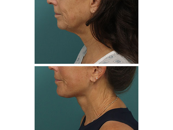 face-neck-rejuv-27-5