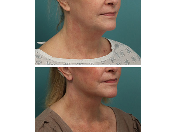 face-neck-rejuv-28-1
