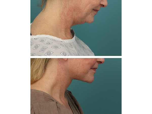 face-neck-rejuv-28-2