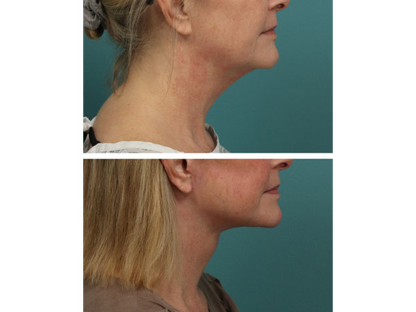 face-neck-rejuv-28-3
