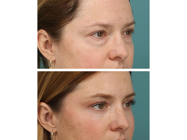eyelid-brow-19-1