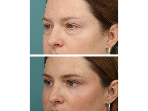 eyelid-brow-19-2