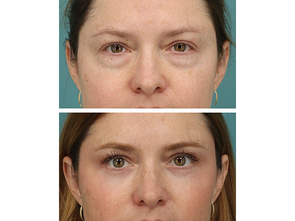 eyelid-brow-19-3