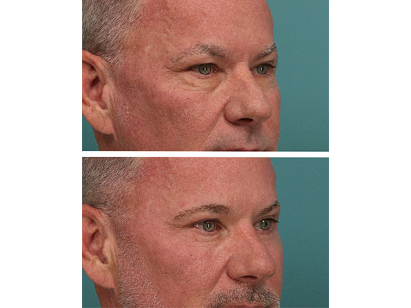 eyelid-brow-20-3