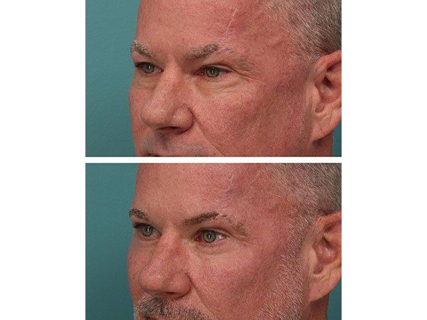eyelid-brow-20-4