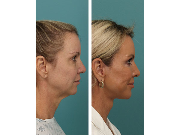 face-neck-rejuv-29-1