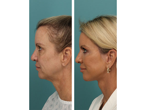 face-neck-rejuv-29-2