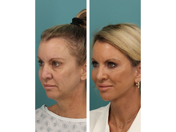 face-neck-rejuv-29-4