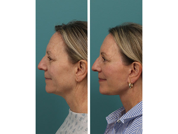 face-neck-rejuv-30-1