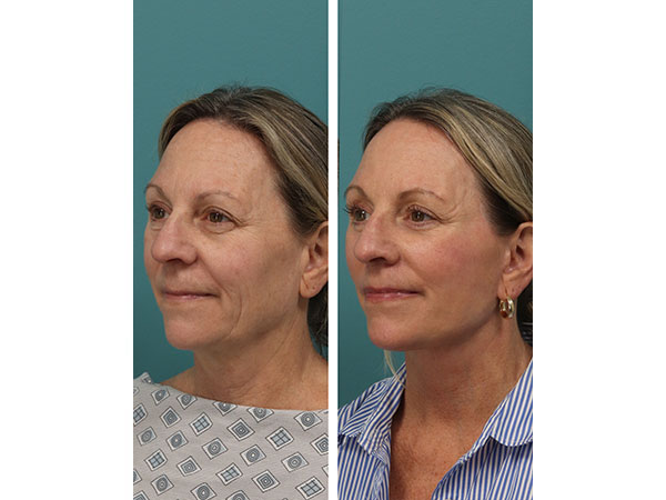 face-neck-rejuv-30-2