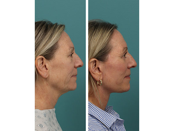 face-neck-rejuv-30-4
