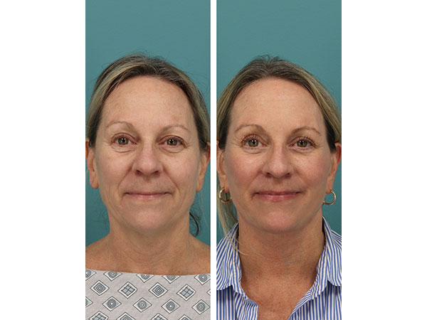 face-neck-rejuv-30-6